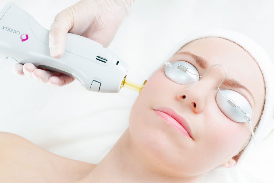 laser hair removal